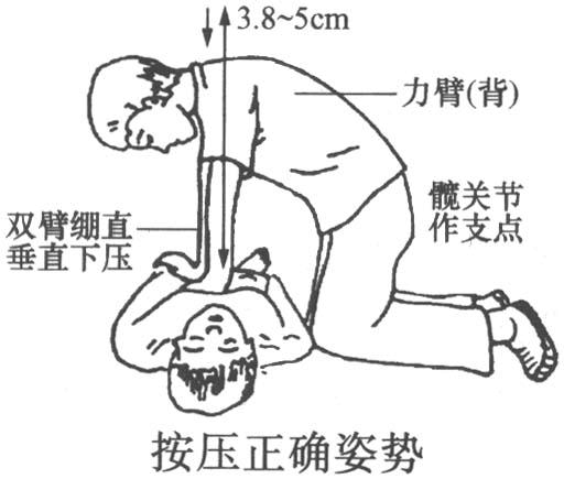 心肺復(fù)蘇模擬人操作常見錯(cuò)誤心肺復(fù)蘇模型易犯錯(cuò)誤